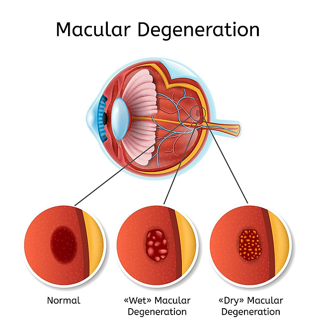 WET DRY AMD